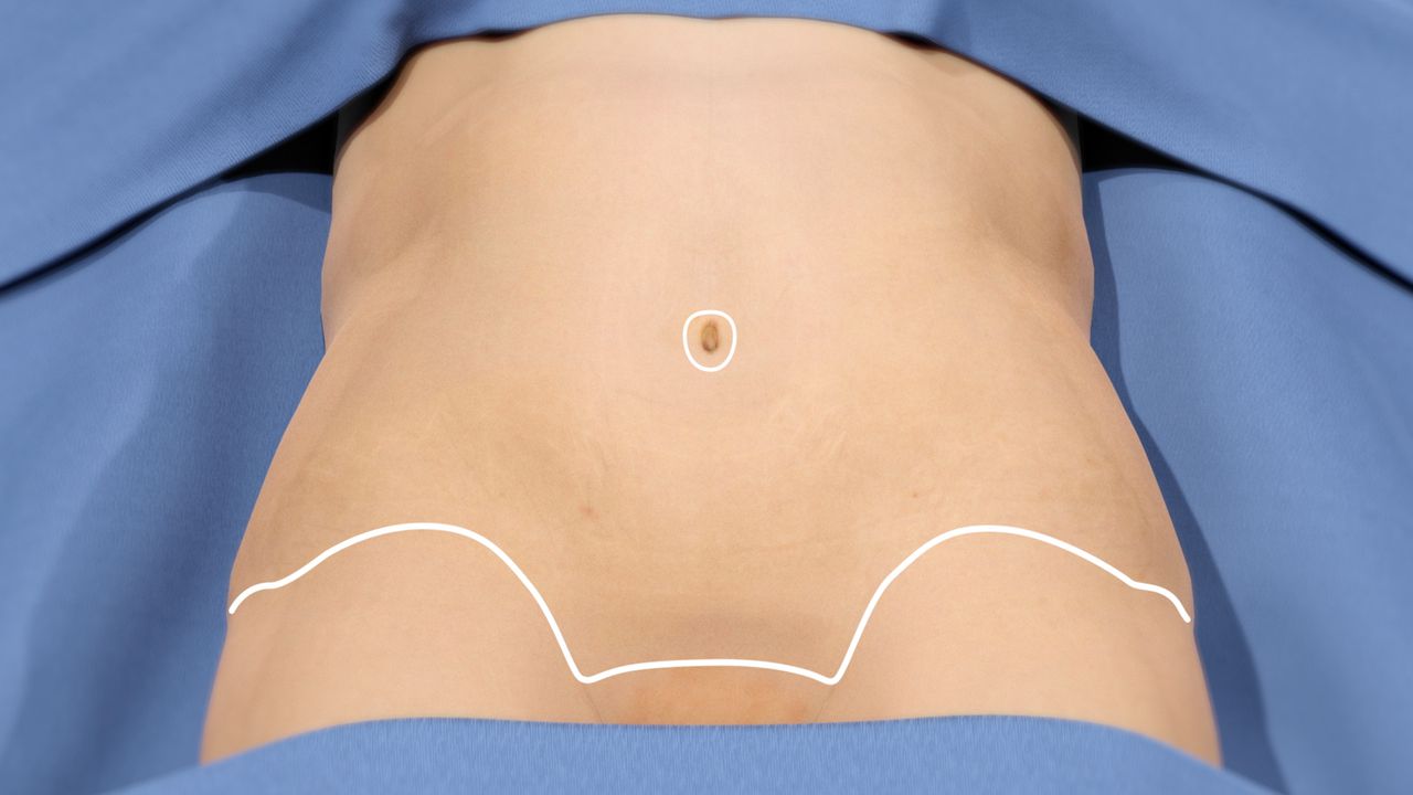 Tummy Tuck Austin