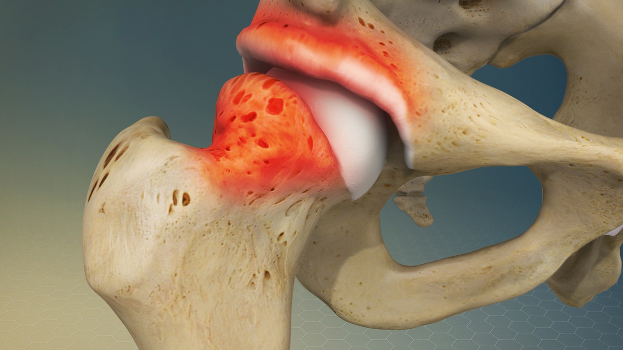 Hip Impingement | Johns Hopkins Medicine