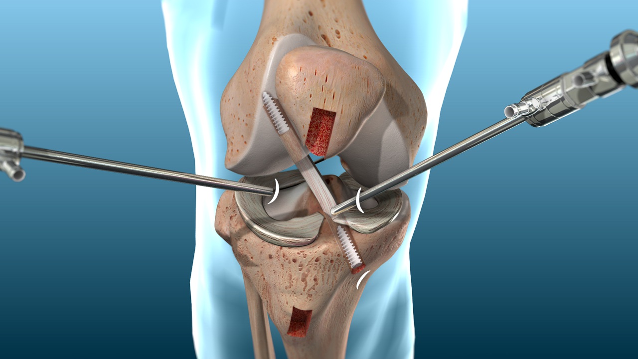 ACL Reconstruction (Patellar Tendon Graft Technique) - Willis Knighton  Health - Shreveport - Bossier City - Ark-La-Tex