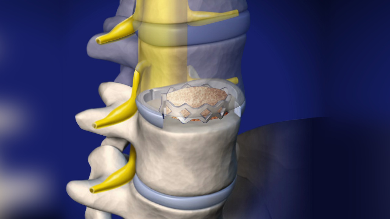 Anterior Lumbar Interbody Fusion (ALIF) Surgical Treatment