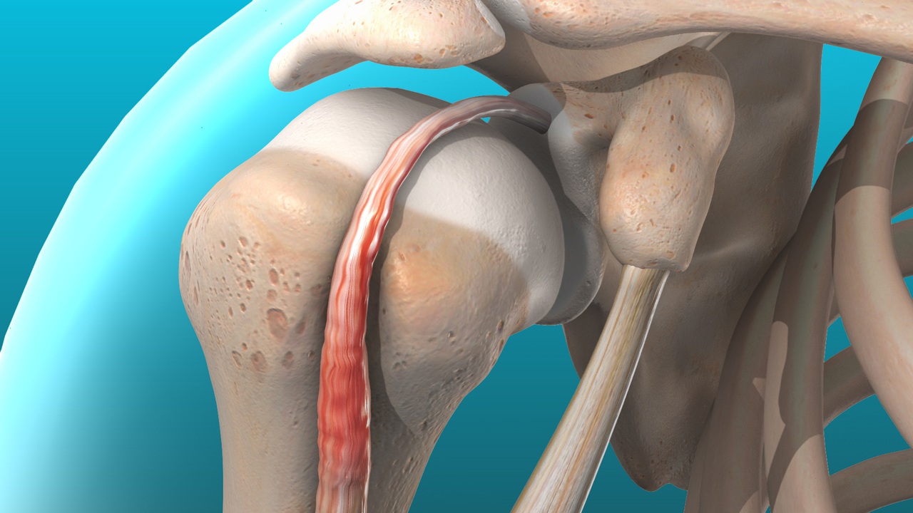 bicep tendonitis bpc 157 Tendonitis: What Causes The Pain and How To Fix It Bicep tendonitis rehab isnt just