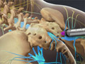 Caudal Epidural Steroid Injection