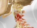 Cervical Radiculopathy
