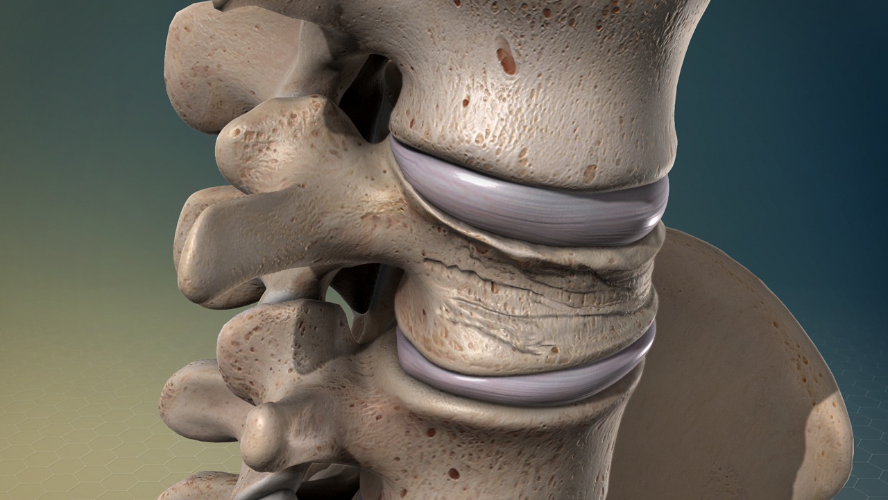 Clavicle Fracture Compensation Naples,  CA 90803