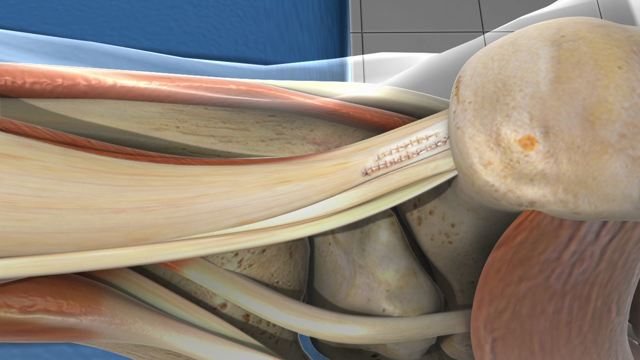 bpc 157 achilles tendon repair Achilles Tendon Rupture Splint main image 0