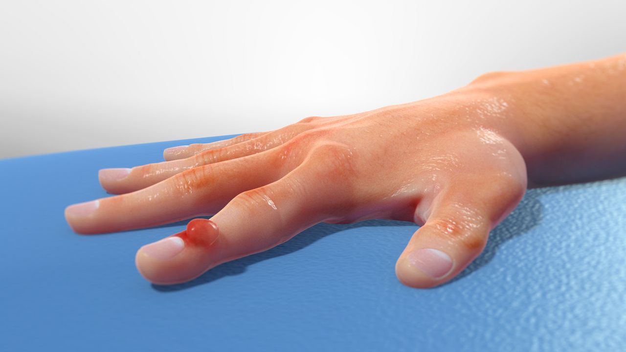 OSS Health | Digital Mucous Cyst Excision