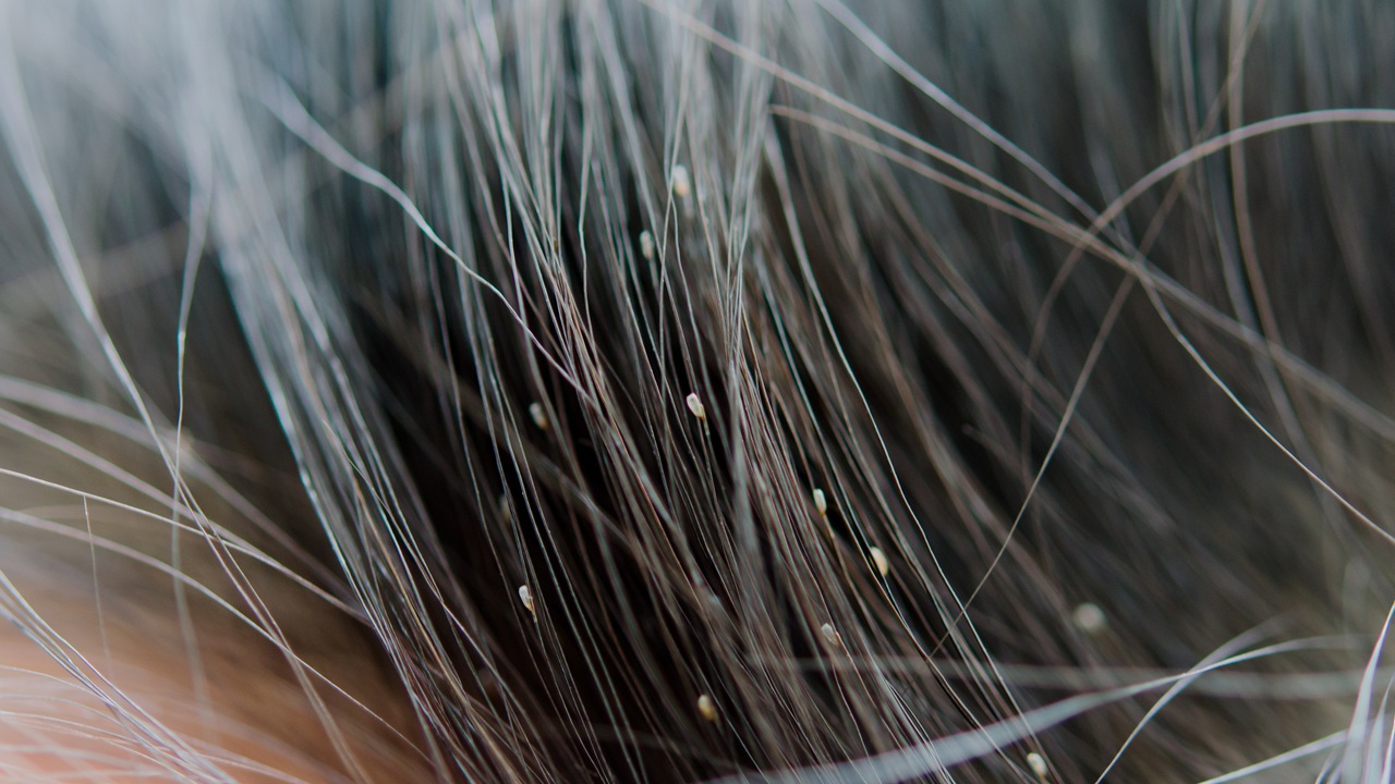 Head Lice - Willis Knighton Health - Shreveport - Bossier City - Ark-La-Tex