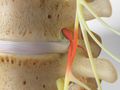 Herniated Discs