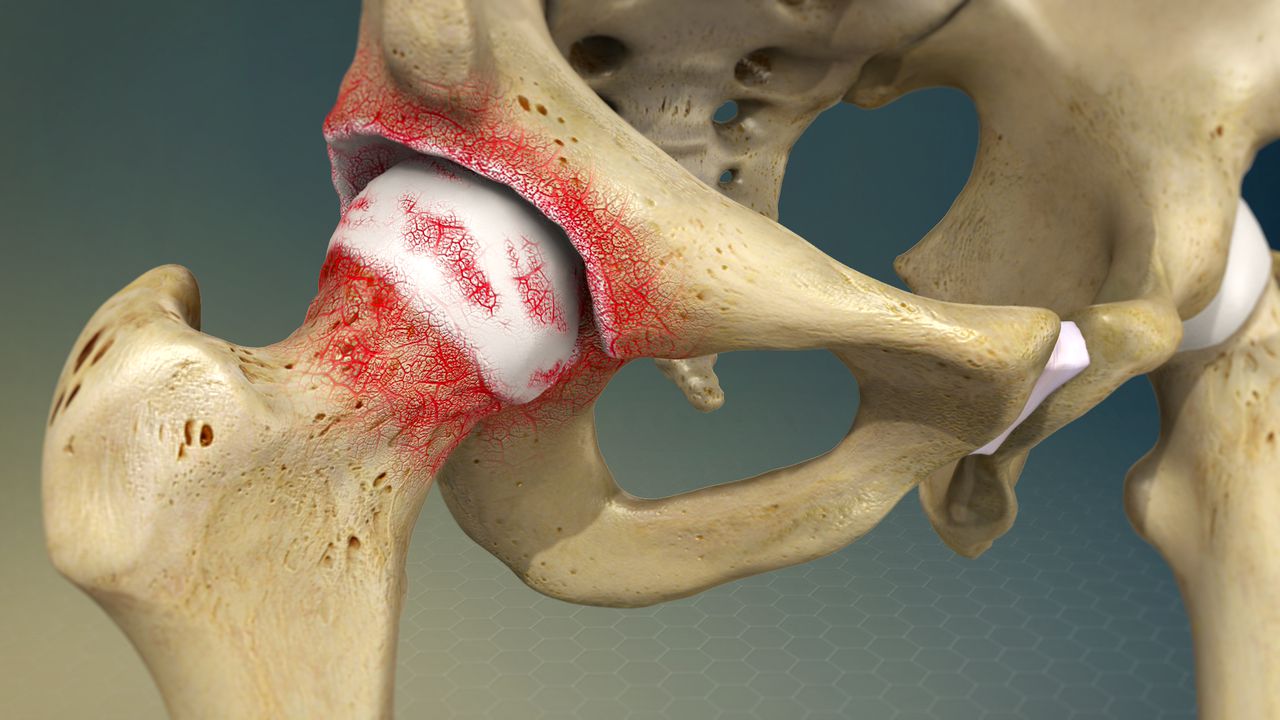 Osteoarthritis | Johns Hopkins Medicine