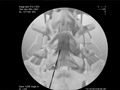 Lumbar Epidural Steroid Injection