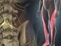Lumbar Radiculopathy (Sciatica)