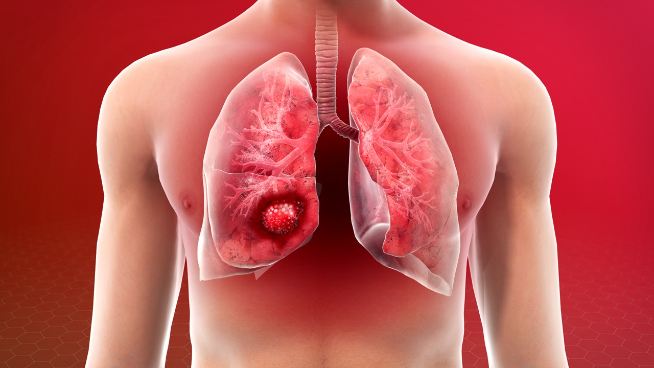 Lung Cancer - Types of Cancer - Willis Knighton Health - Top Hospitals and Doctors in Shreveport - Bossier City and the Ark-La-Tex