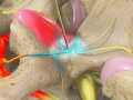 Medial Branch Block