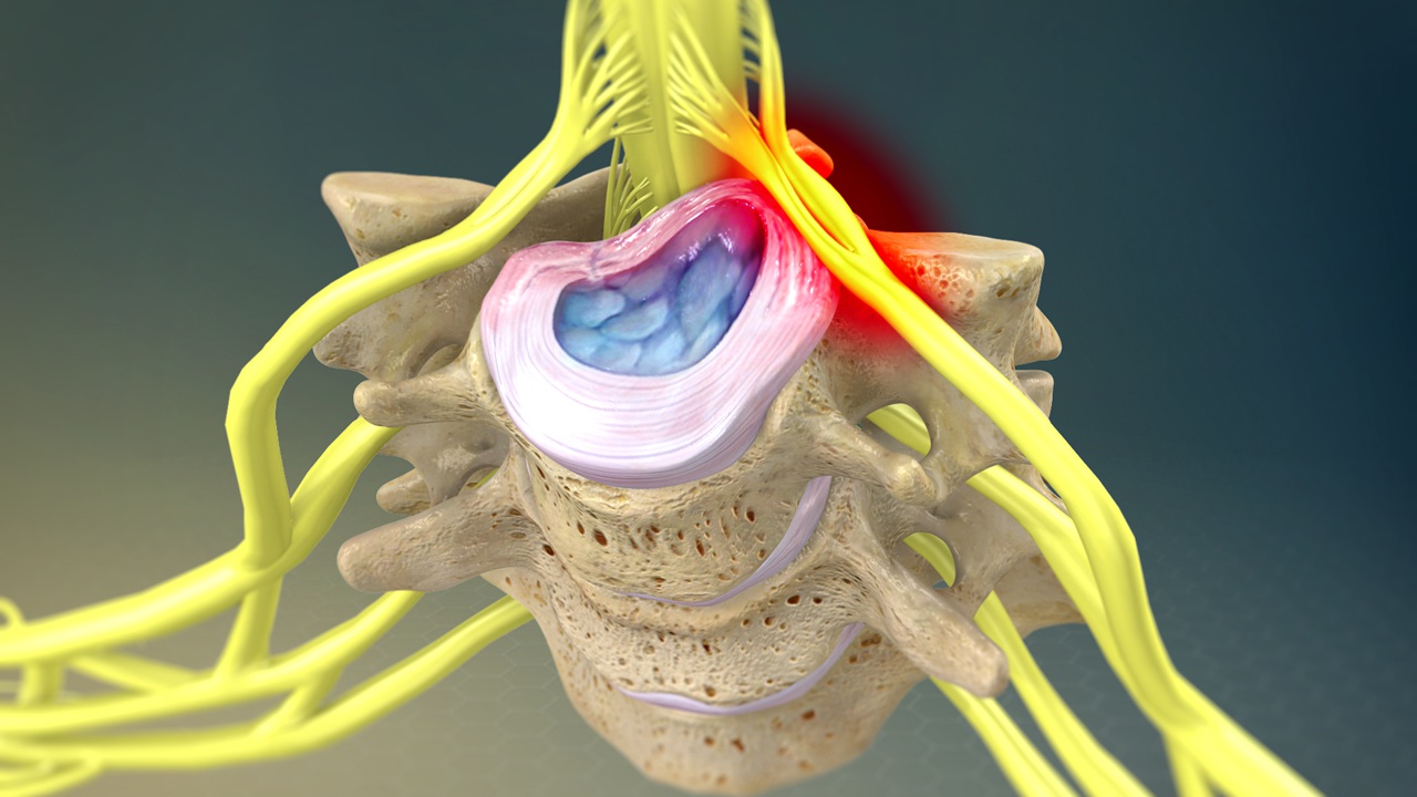 neck pain