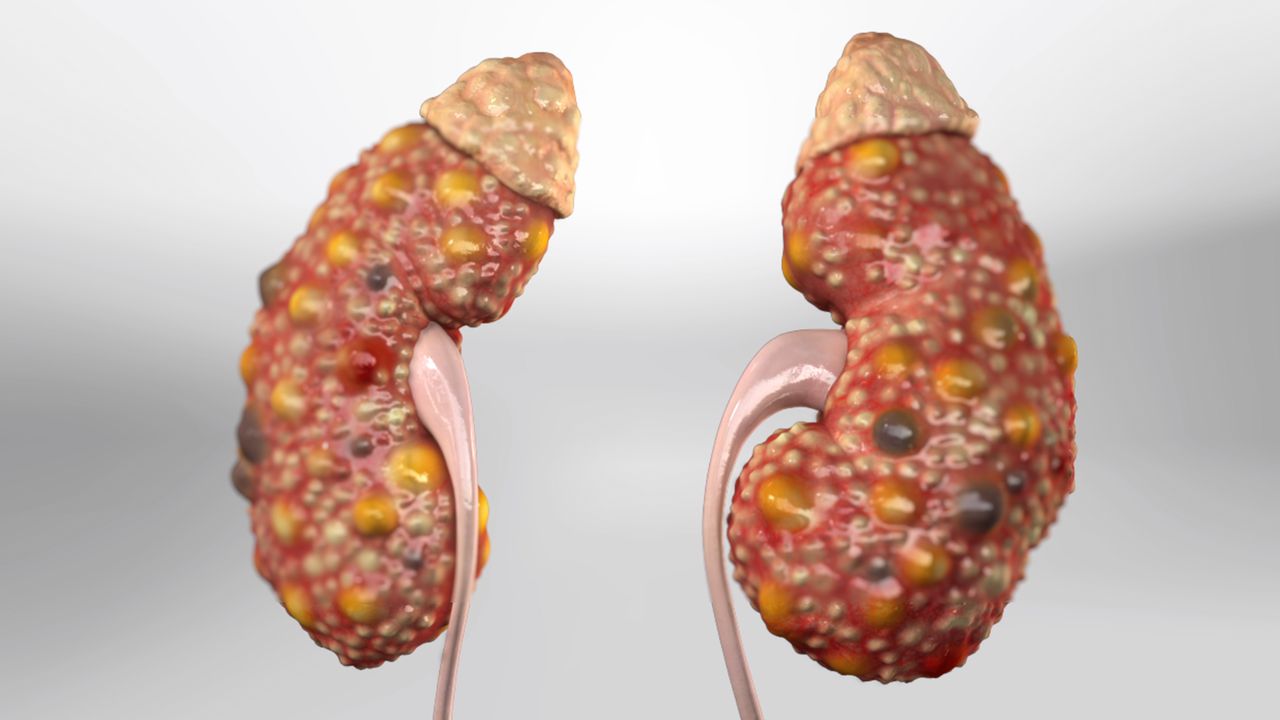 Polycystic Kidney Disease-Causes-Symptoms-Diagnosis-Best-Treatment-Options-Homeopathic-Dr-Qaisar-Ahmed