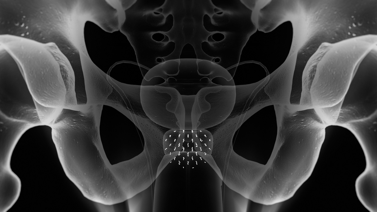 do-palladium-radiation-pellets-dissolve-in-the-prostate-sale