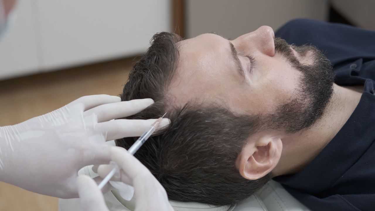 PRP Therapy for Hair Loss