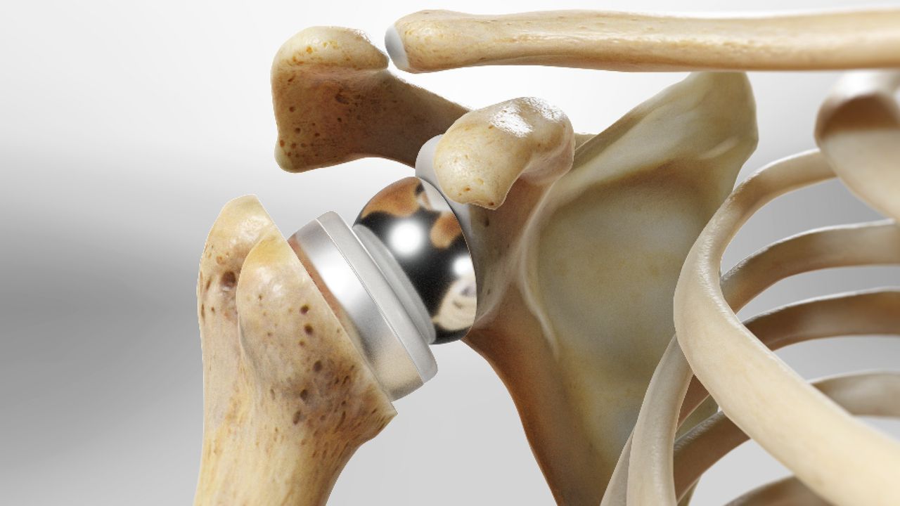 When Should You Consider Shoulder Replacement Surgery? 6 reversetotalsho 1280