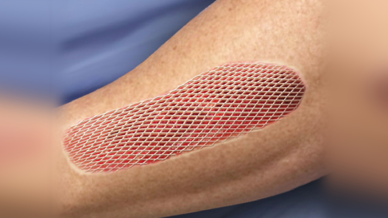 Skin Grafting - Willis Knighton Health - Shreveport - Bossier City ...