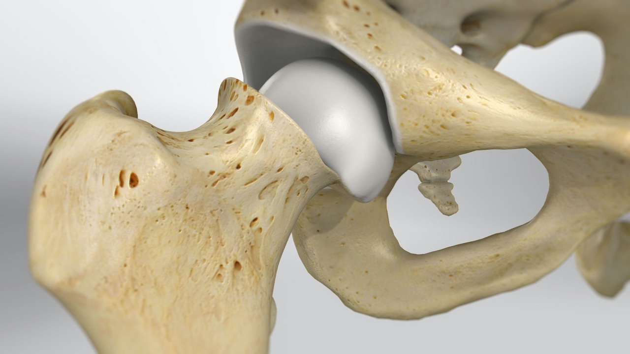 Slipped Capital Femoral Epiphysis | Johns Hopkins Medicine