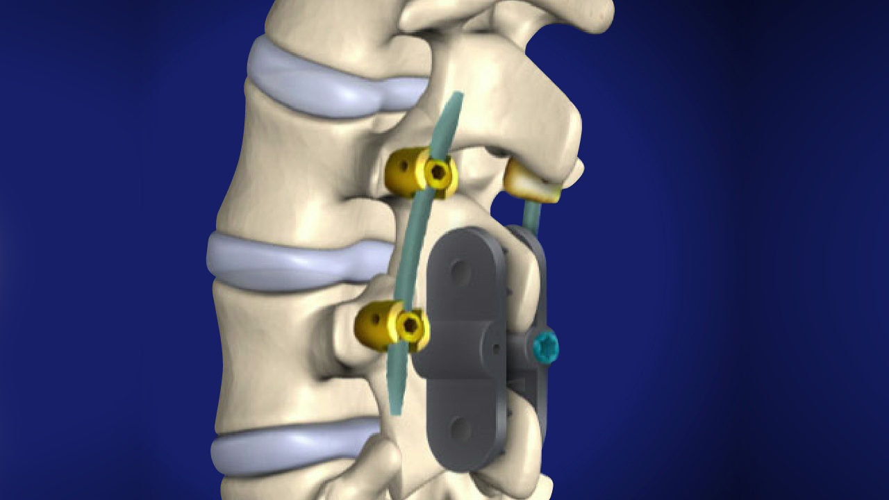 Lumbar Spinous Process Plating (CD Horizon® SPIRE) - Willis