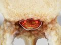 Spinal Stenosis