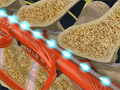 Spinal Cord Stimulator Implant