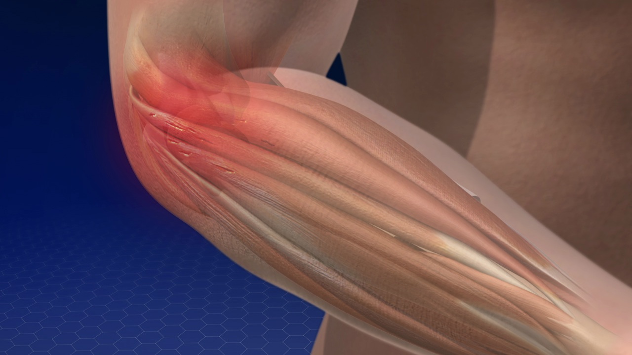 Lateral Epicondylitis (Tennis Elbow) | Johns Hopkins Medicine