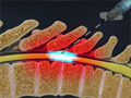 Thoracic Epidural Steroid Injection