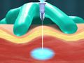 Trigger Point Injections