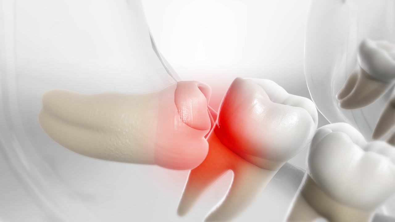 Emergency Dental Extraction Near Me Rosedale, NY